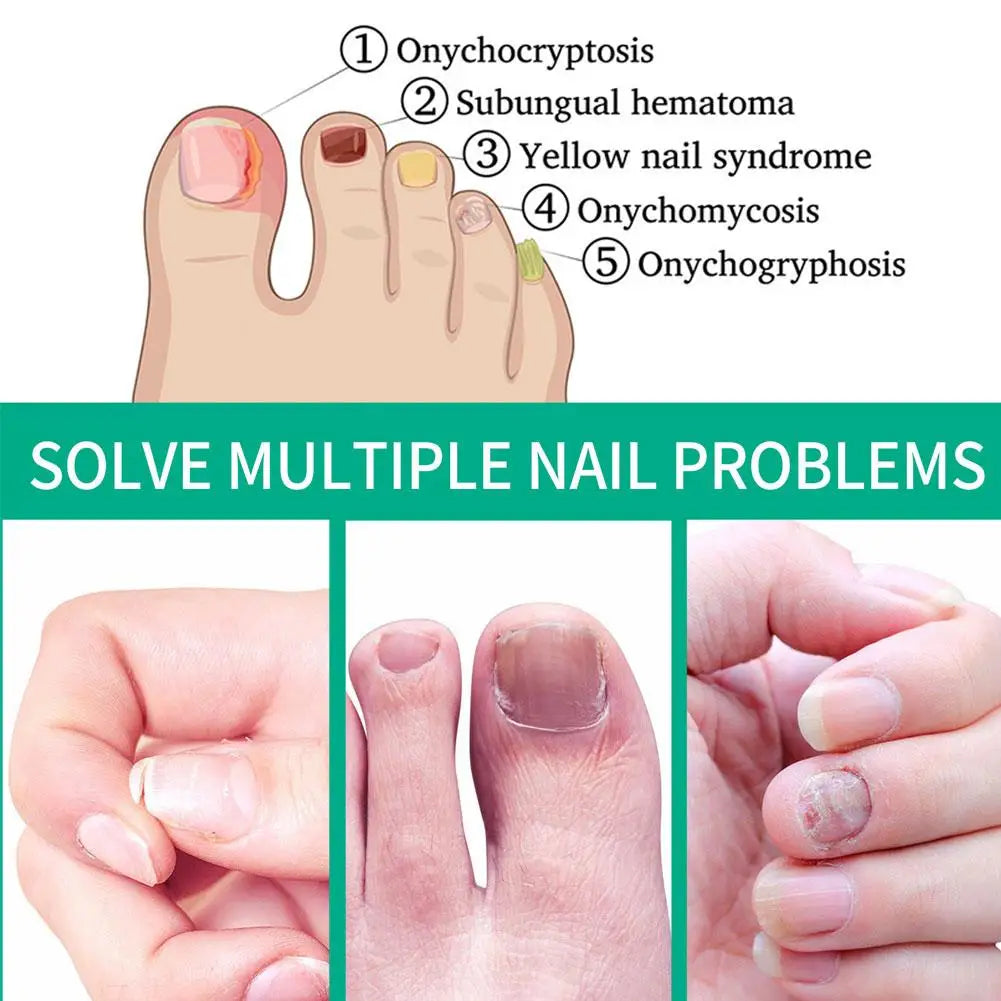 5-Pack Nail Repair Serum | Nail Restoration Essence 10ml