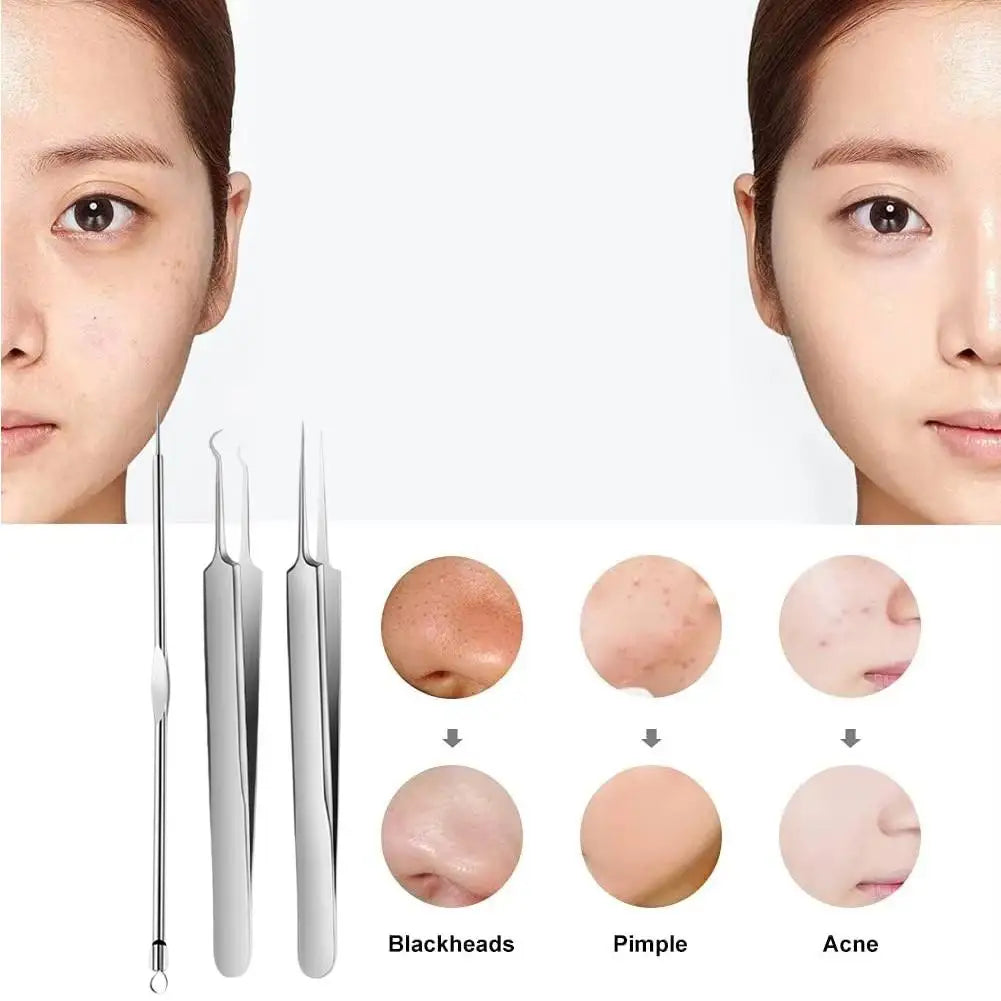 3-Piece Stainless Steel Acne Needle & Blackhead Remover Kit