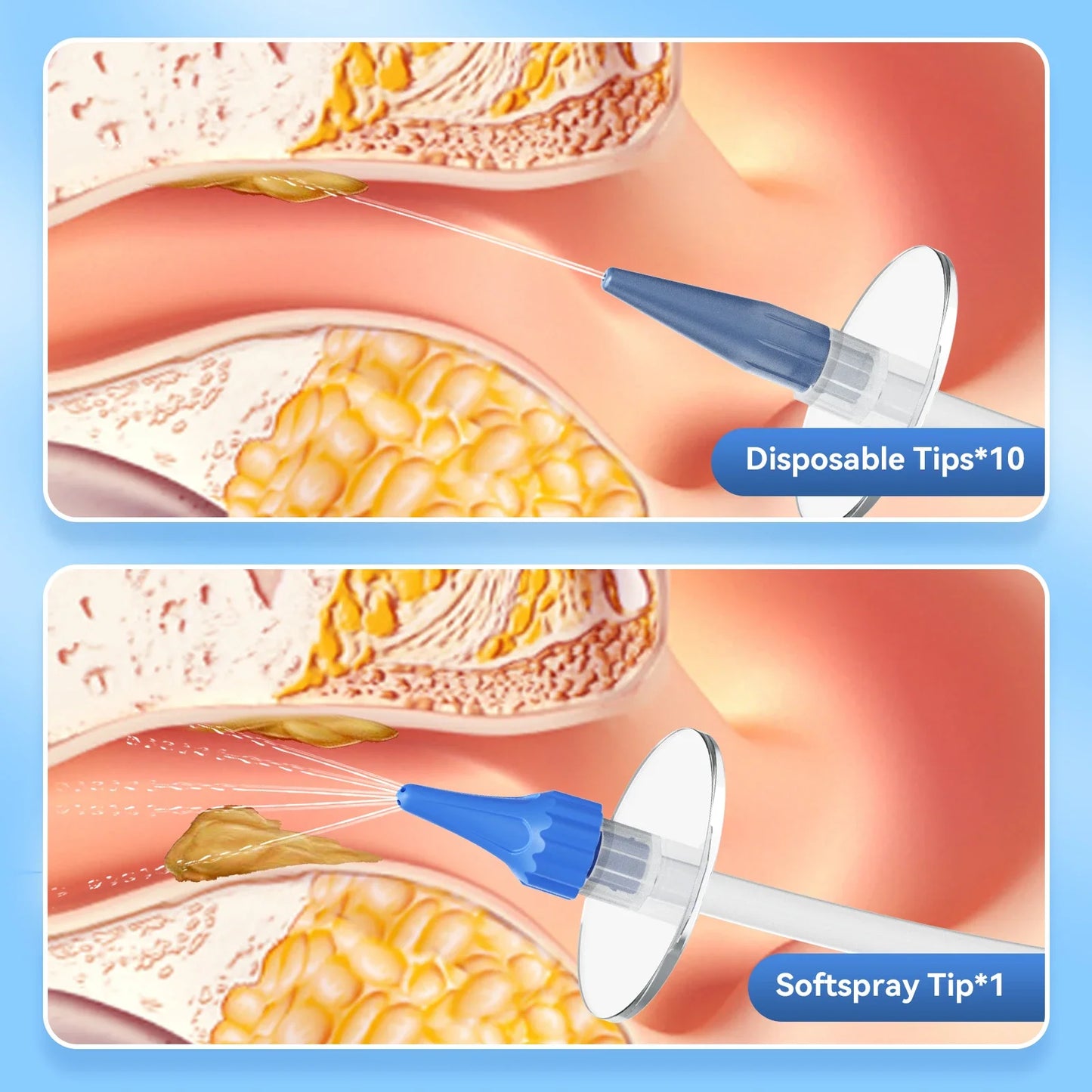 Ergonomic Ear Wax Removal Kit | Silicone Tips & Water Tank