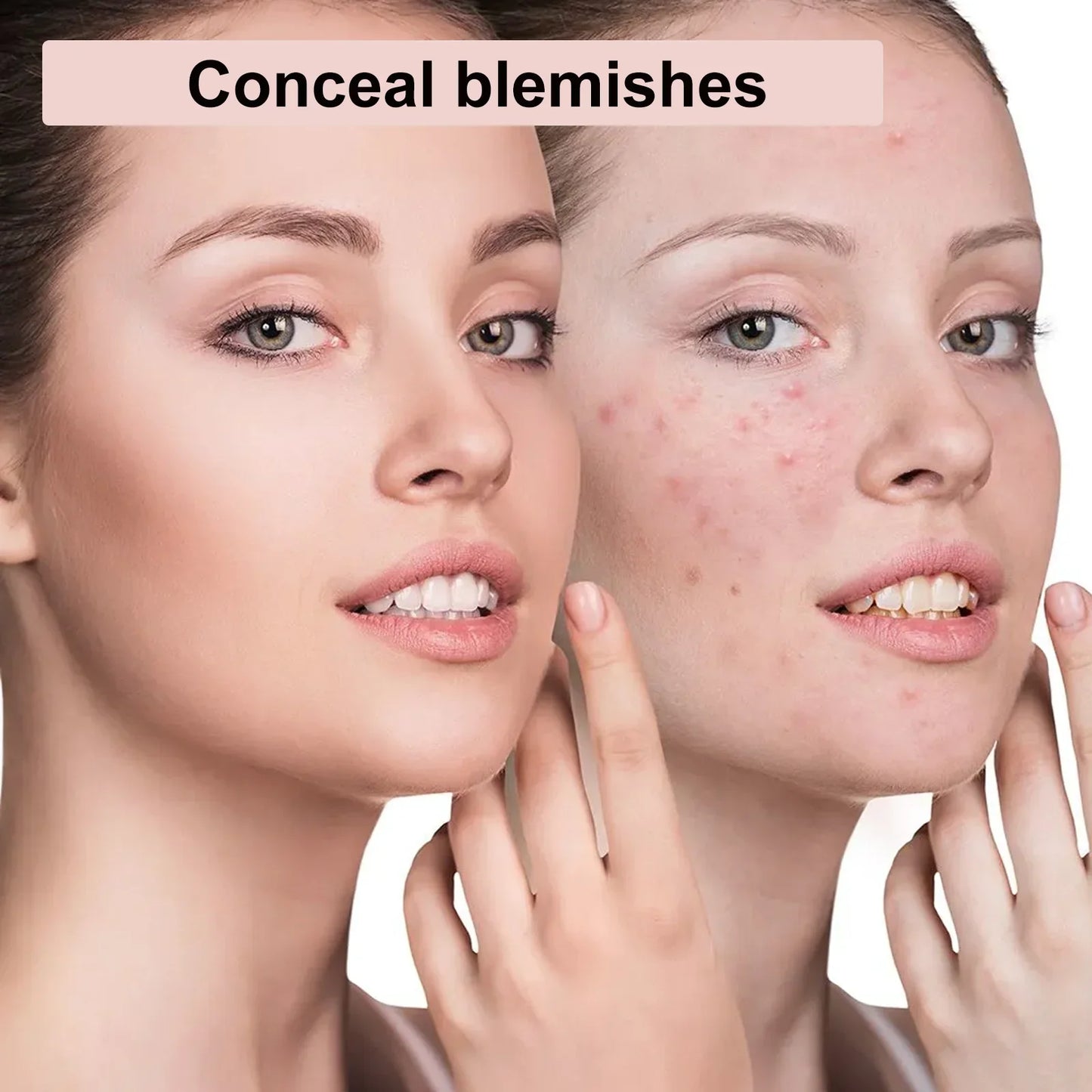 88-Pc Hydrocolloid Pimple Patches – Invisible Overnight