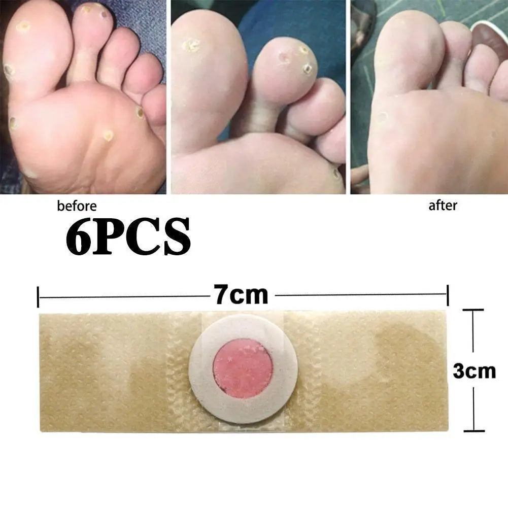 6-Pack Corn & Callus Remover Pads – Self-Stick Foot Patches