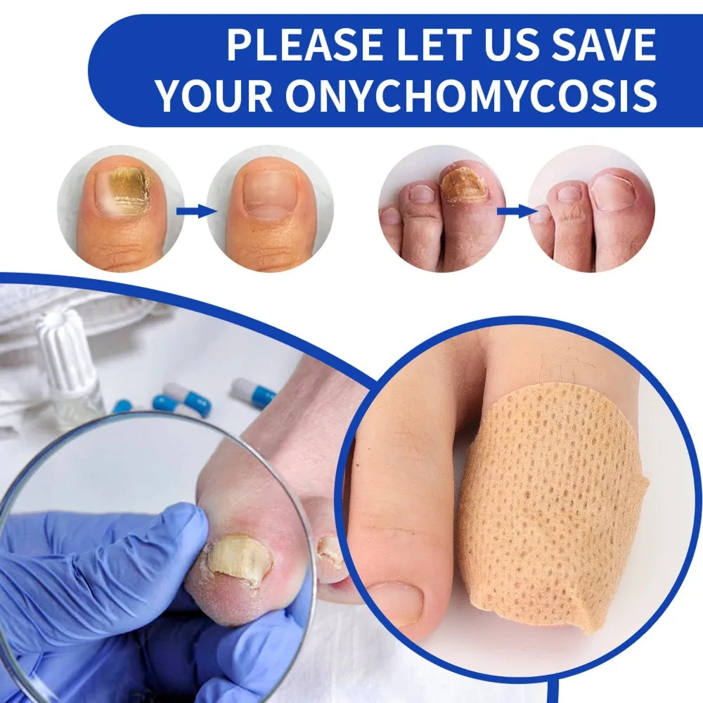 Nail Repair Patches – Ingrown Toenail & Nail Care Stickers
