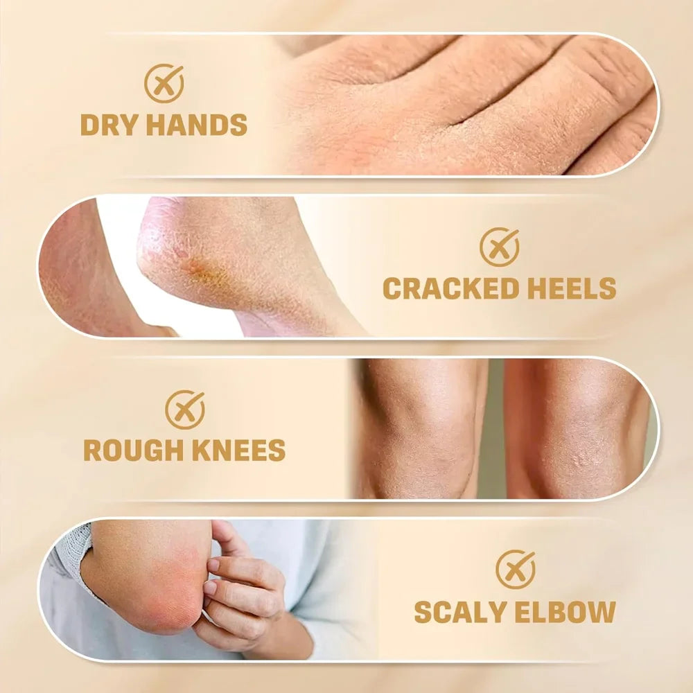 Urea Cream 60g – Cracked Heels, Dry Hands & Rough Skin Repair