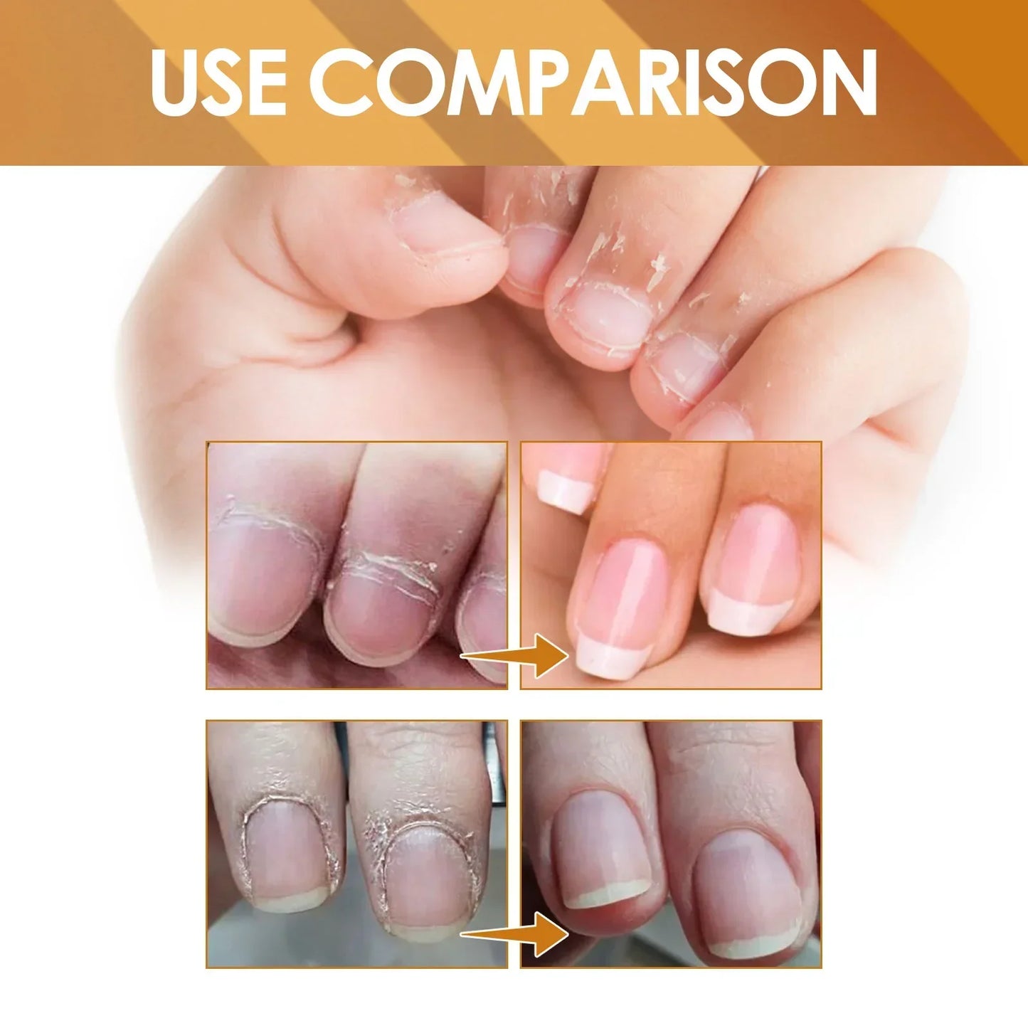 EELHOE Cuticle Removal Gel – Nail Softener & Dead Skin Remover