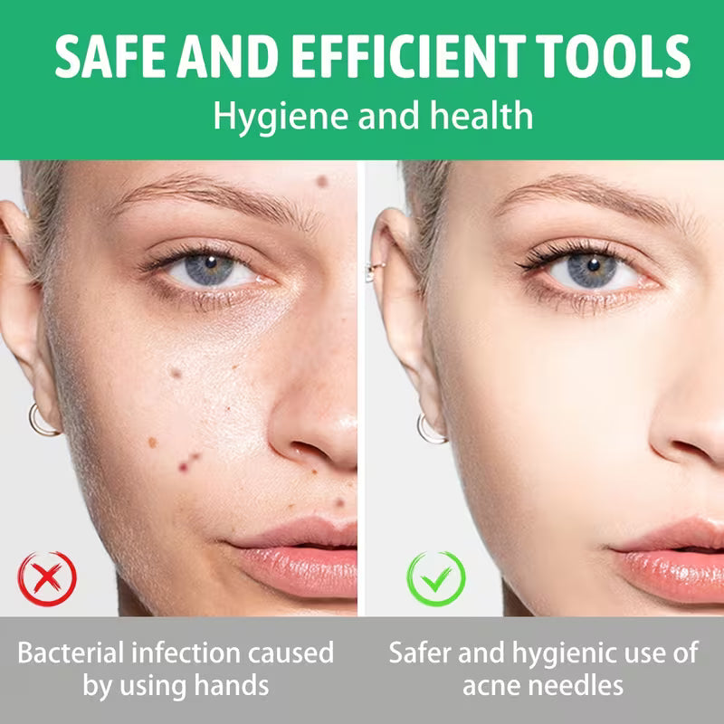 Before and after comparison of a person's face with acne, showing the impact of bacterial infection and safer use of acne needles.