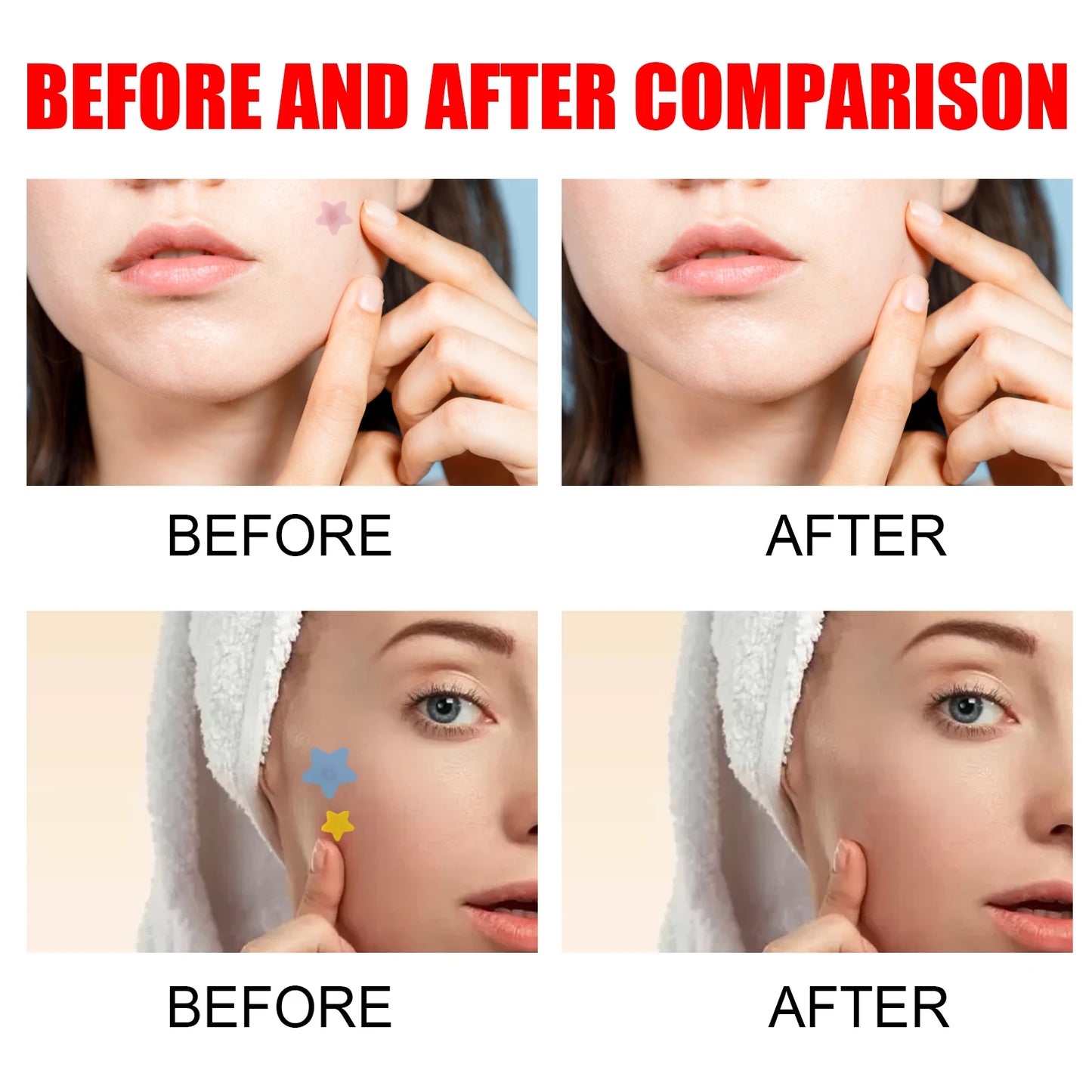 Jaysuing 200-Piece Star Acne Patches – Hydrocolloid Blemish Dots