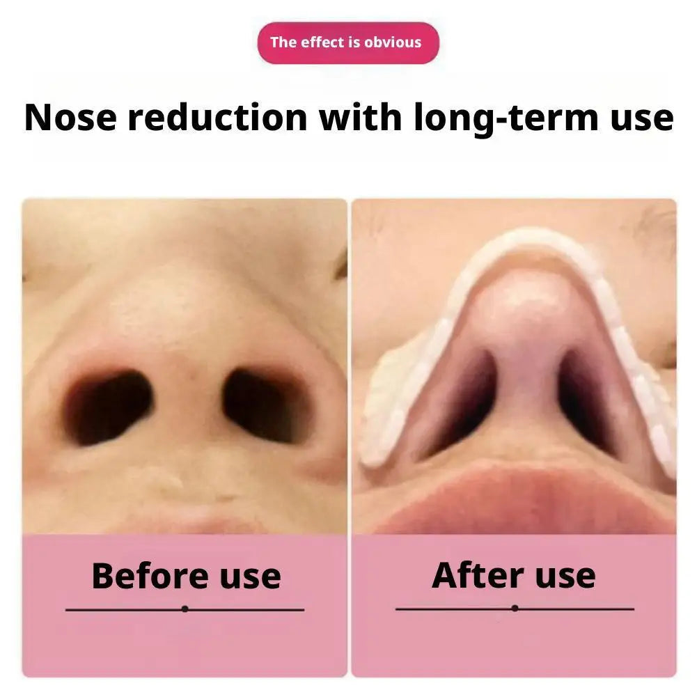Thermoplastic Nasal Splint Brace – Moldable Nose Support