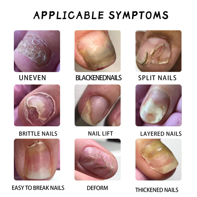 Eelhoe Nail Repair Serum – Ginger Extract for Healthy Nails