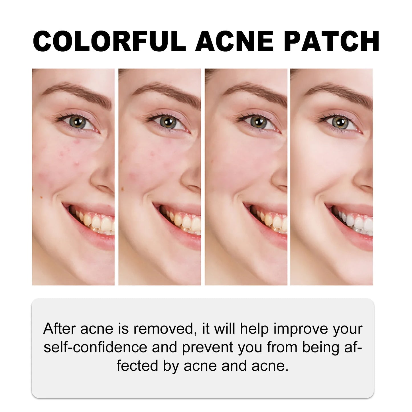 Acne Treatment Patch Absorbing Acne Cover Blemish Anti Infection Waterproof Spot Marks Concealer Colorful Pimple Removal Sticker Peaceful Pleasures Health and Wellness