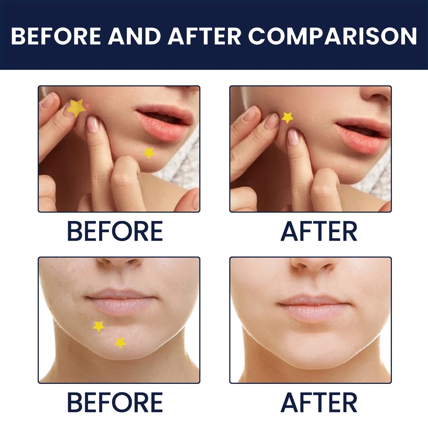 Waterproof Hydrocolloid Acne Patches – Invisible 2-in-1 Skin Care