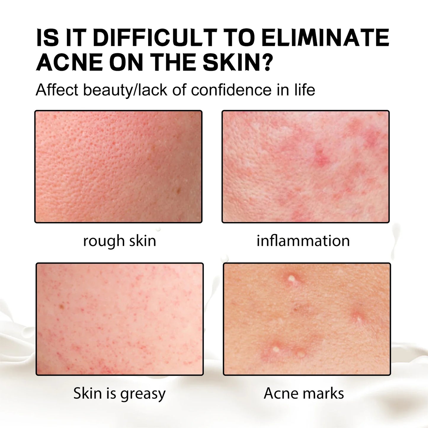 Jaysuing Back Acne Soap – Deep Cleanse, Exfoliate & Fade Spots