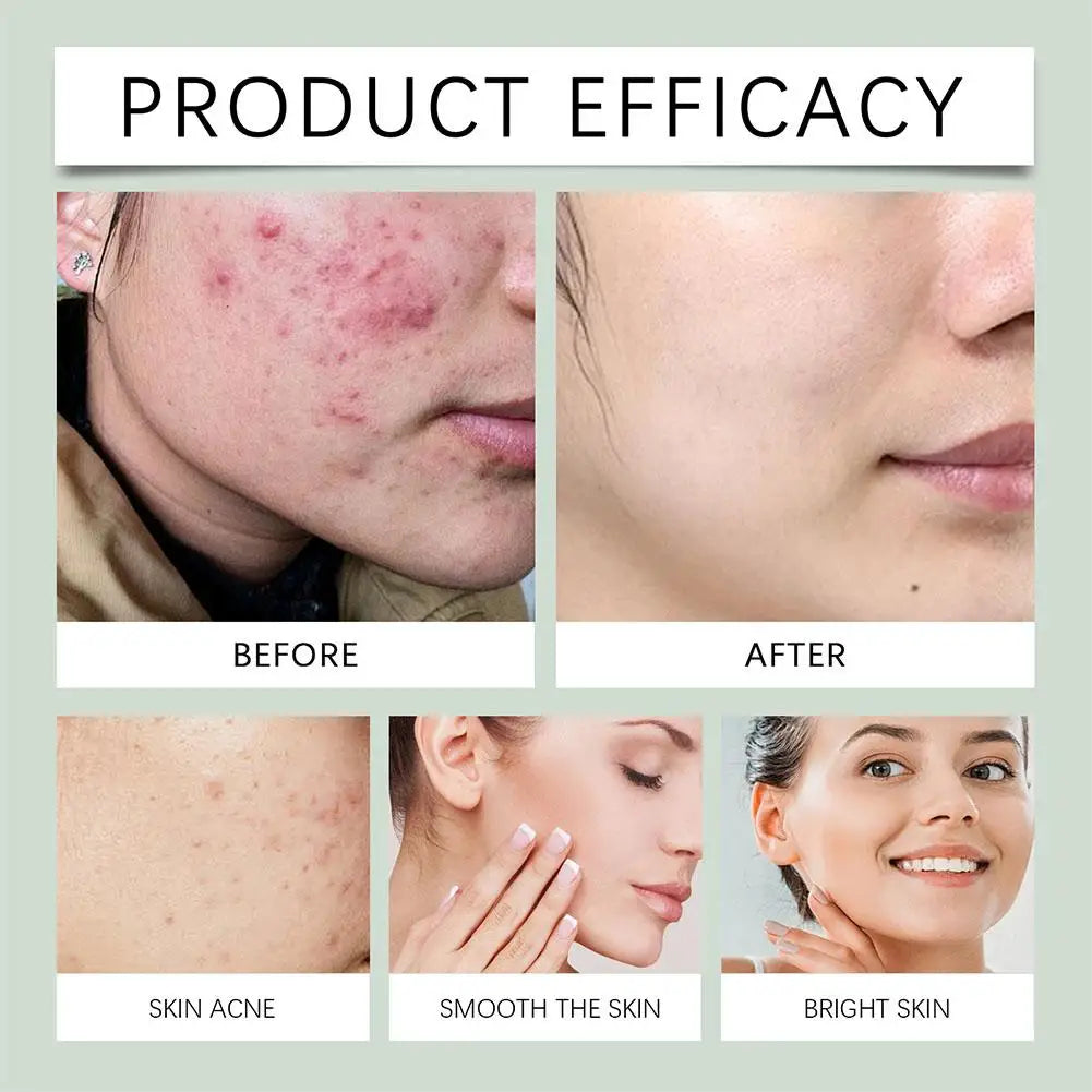 Salicylic Acid Acne Treatment Face Serum Repair Pimple Spots Deep Cleaning Pore Anti-acne Scar Oil Control Moisturizer Skin Care Peaceful Pleasures Health and Wellness
