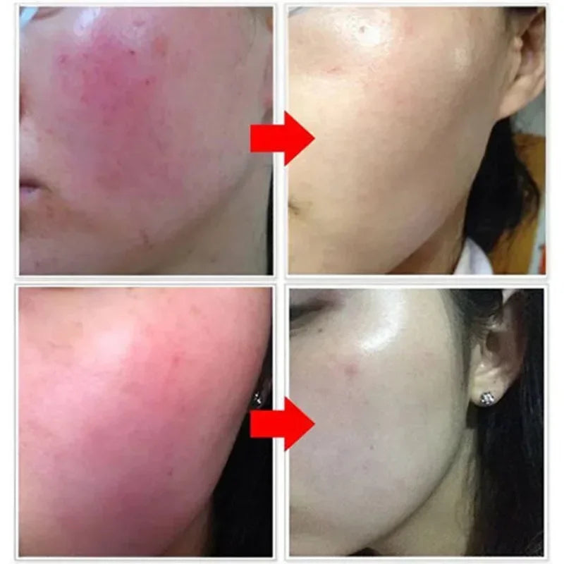 Facial Redness Repair Serum | Sensitive Skin & Rosacea, 30ml