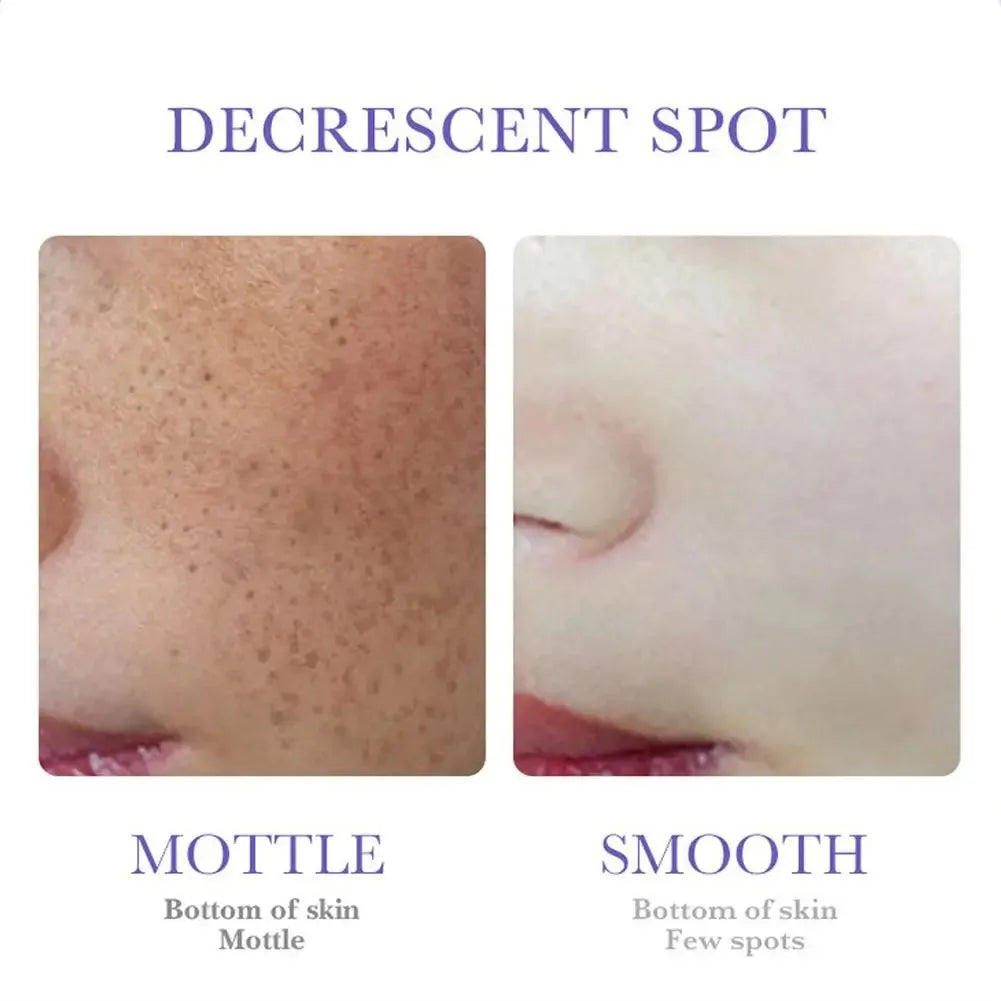 SADOER Nicotinamide Remove Melasma Dark Spot Whiten Freckle Cream Lighten Melanin Brightens Skin Tone Moisturize Face Skin Care Peaceful Pleasures Health and Wellness