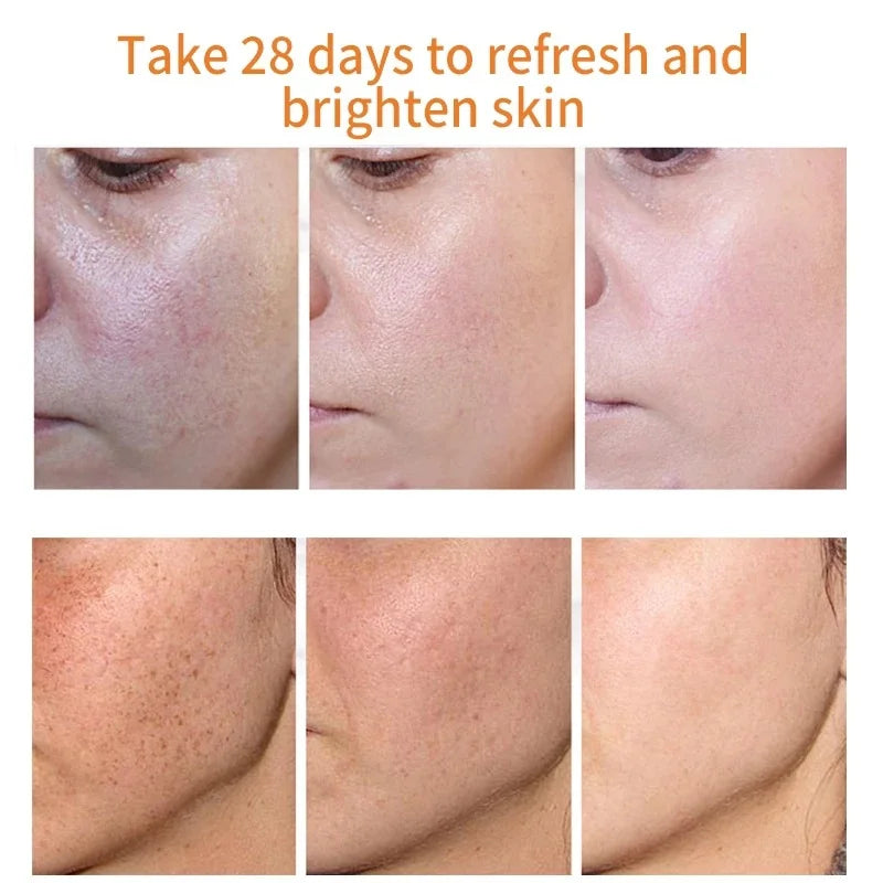 Effective Whitening Freckles Cream Remove Melasma Dark Spots Fade Melanin Pigmentation Moisturizing Brighten Skin Care Products Peaceful Pleasures Health and Wellness