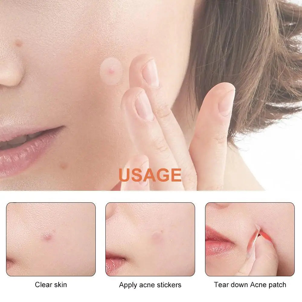 Ultra-Thin Invisible Pimple Patches – 72 or 288 Count