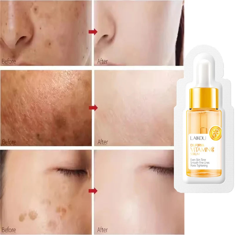 Vitamin C Whitening Serum Freckle Remove Essence Fade Pigmentation Melasma Dark Spots Corrector Repair Serum Korean Skin Care Peaceful Pleasures Health and Wellness