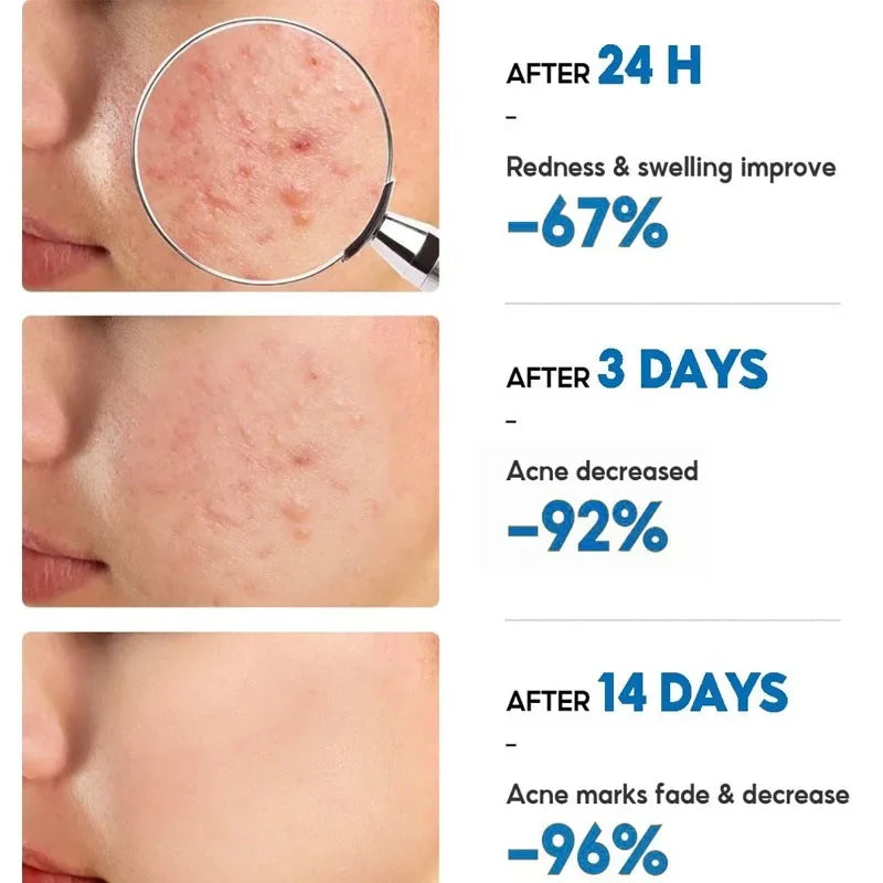 Salicylic Acid Acne Removal Cream Anti-Acne Repair Redness Pimple Spots Deep Cleaning Pore Oil Control Moisturizing Skin Care Peaceful Pleasures Health and Wellness