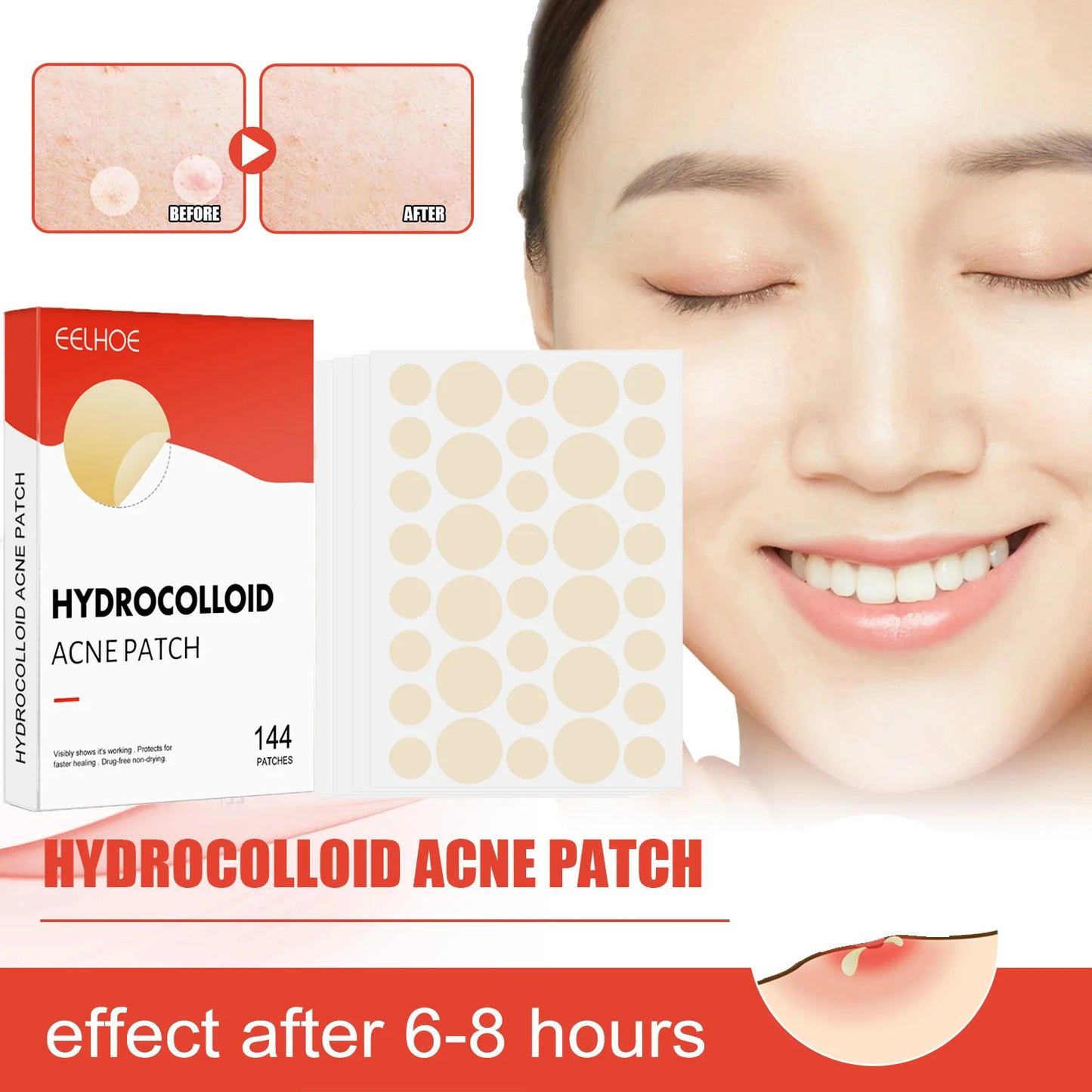 Hydrocolloid Acne Patches 144pc – 2 Sizes, Invisible Spot Treatment