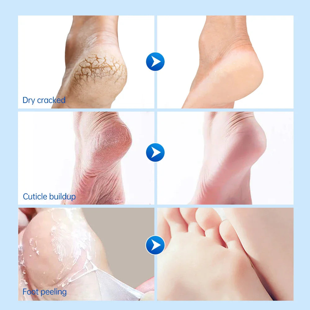 JoyPrettyin 42% Urea Foot Cream – Exfoliating & Moisturizing