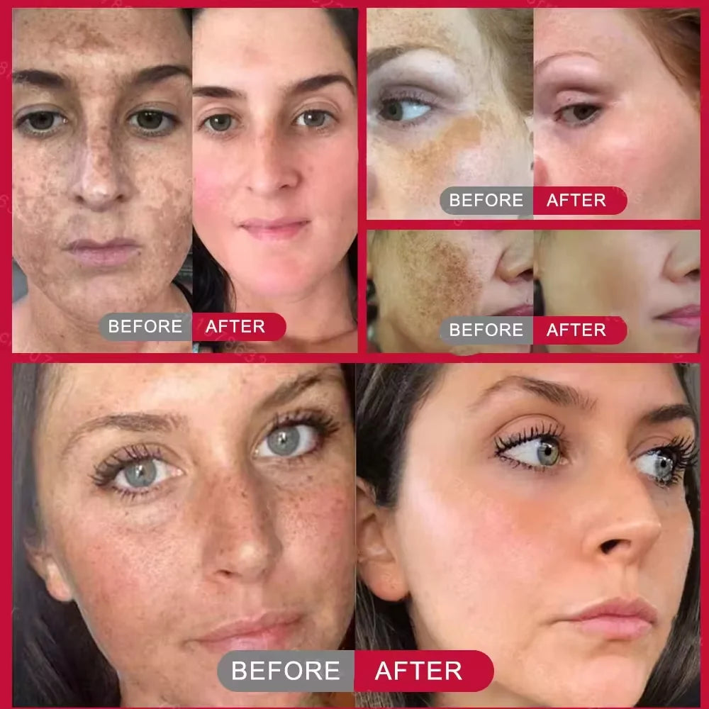 Effective Whitening Freckles Face Cream Removal Melasma Dark Spots Fade Melanin Pigmentation Corrector Brighten Repair Skin Care Peaceful Pleasures Health and Wellness