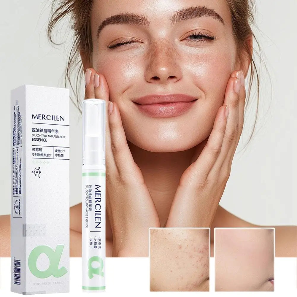 Salicylic Acid Acne Treatment Face Serum Repair Pimple Spots Deep Cleaning Pore Anti-acne Scar Oil Control Moisturizer Skin Care Peaceful Pleasures Health and Wellness