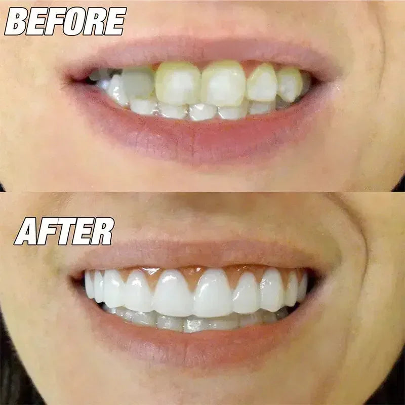 New False Teeth Silicone Upper & Lower Veneers Perfect Laugh Veneers Dentures Paste Fake Teeth Braces Comfortable Teeth Peaceful Pleasures Health and Wellness