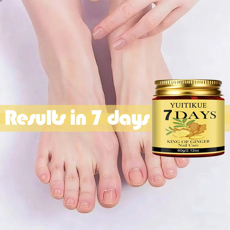 YUITIKUE Ginger King Nail Cream – 7-Day Nail Care, 60g Nail Treatment Cream Peaceful Pleasures Health and Wellness