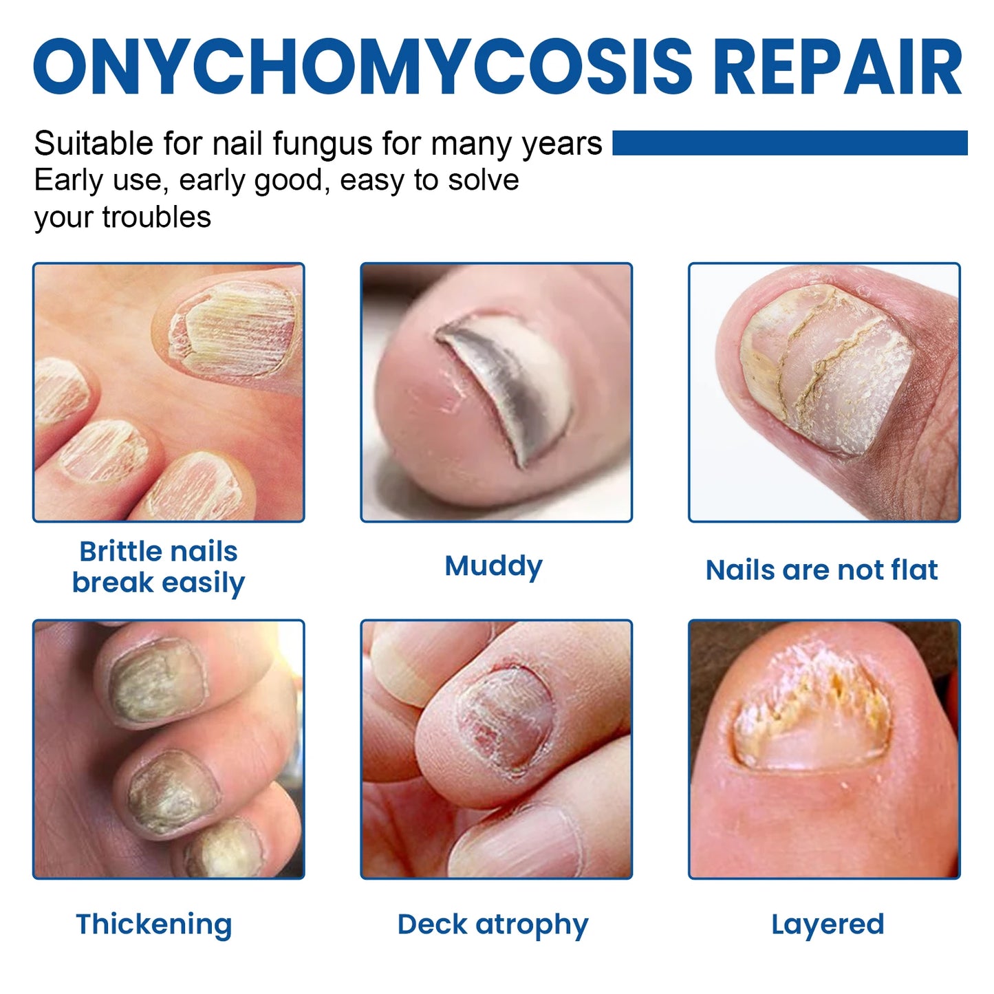Nail Repair Patches – Ingrown Toenail, Fungus & Brittle Nail