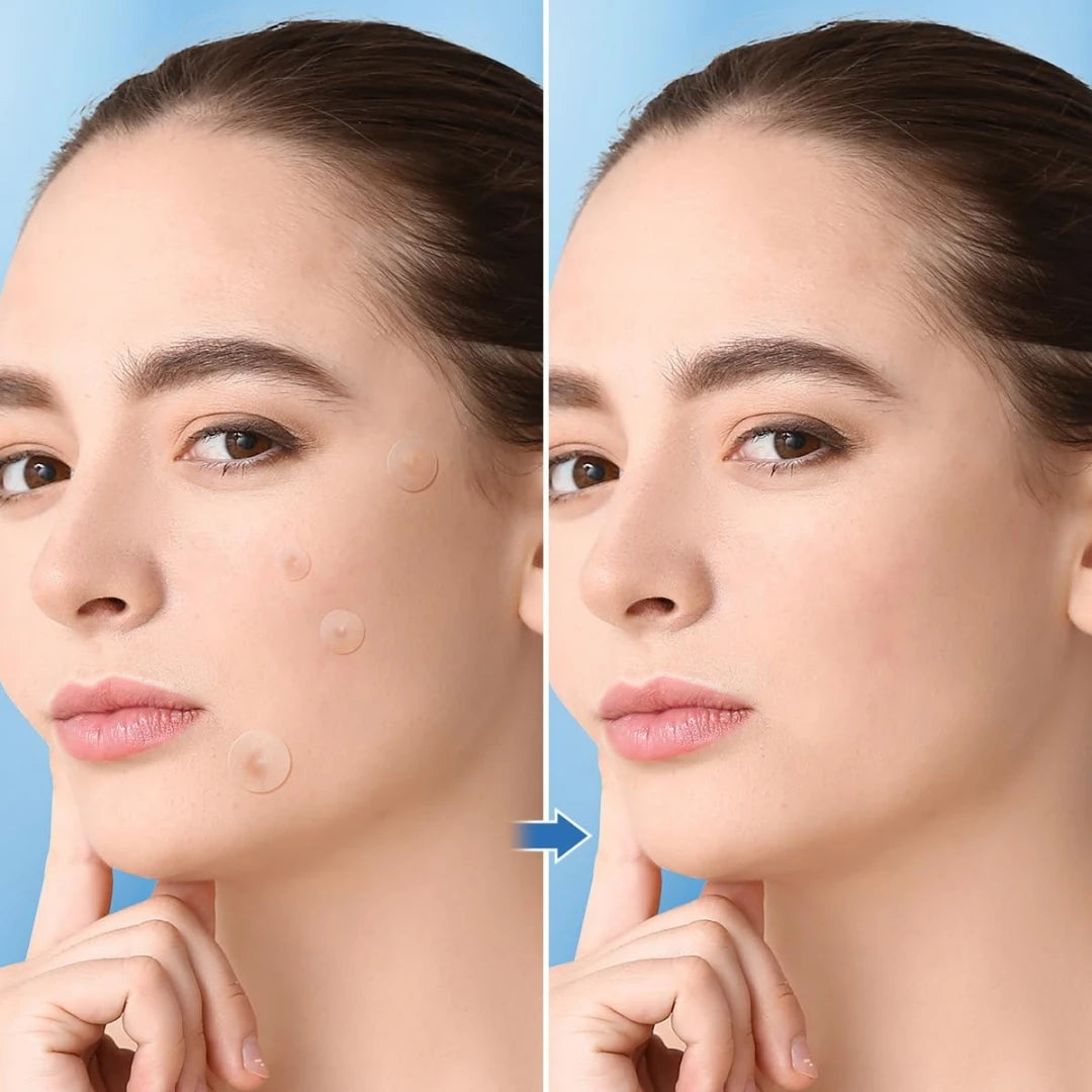 Hydrocolloid Acne Patches – Invisible, Waterproof, All Skin Types