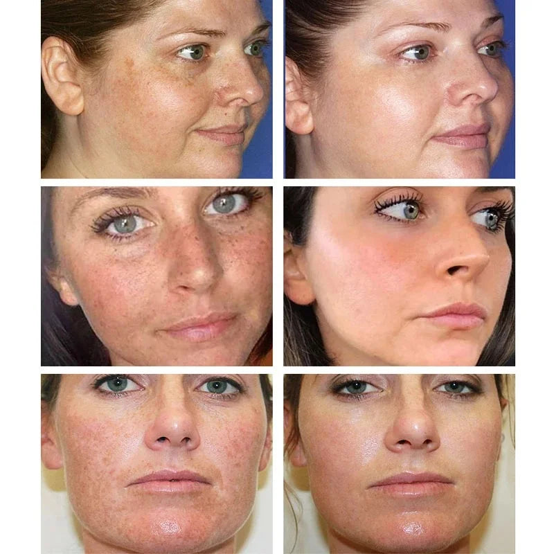 Effective Whitening Freckles Cream Remove Melasma Dark Spots Fade Melanin Pigmentation Moisturizing Brighten Skin Care Products Peaceful Pleasures Health and Wellness
