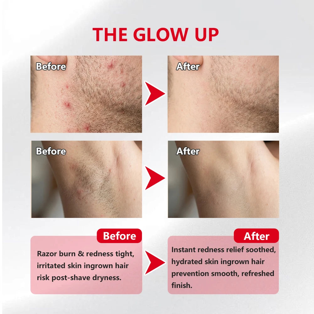 Ingrown Hair Care Pads Aftershave Treatment Powerful Gentle Formula Soothe Skin For Men & Women Underarms Bikini Area Face Neck Peaceful Pleasures Health and Wellness