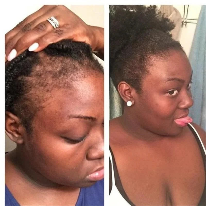 100ML Hair Shampoo For Fast Hair Growth Rosemary Onion Shampoo 30ML Spray Anti Hair Loss Effective Within 7 Day Hair Growth Peaceful Pleasures Health and Wellness