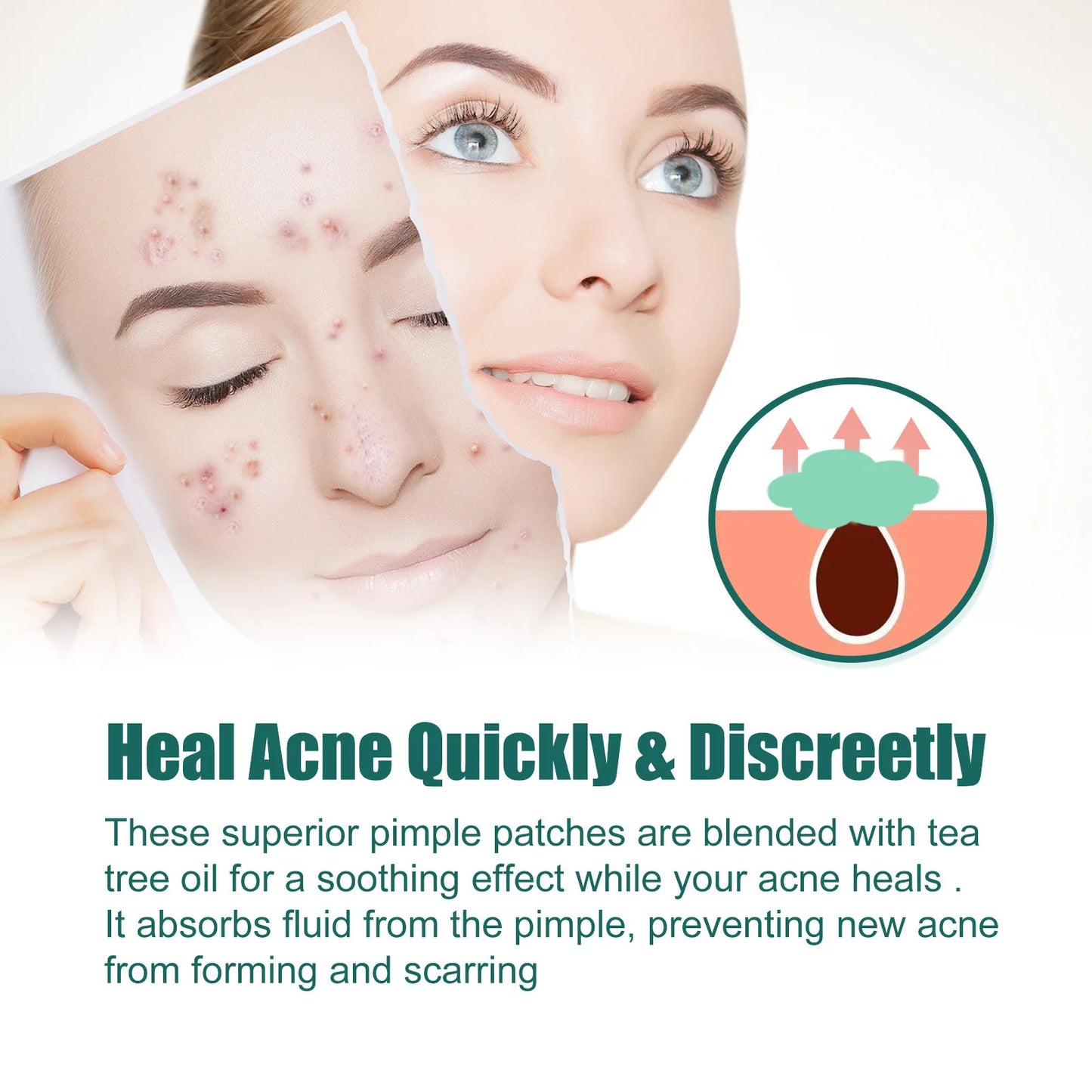 EELHOE Salicylic Acid Acne Patches 112pcs | Pimple Stickers
