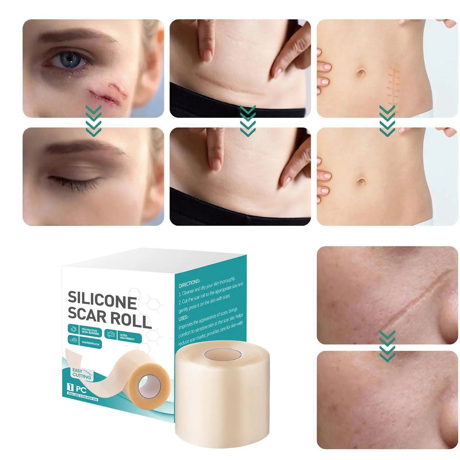 Hydrocolloid Silicone Scar Sheet Roll | Self-Adhesive Patch 4×150cm Silicone Scar Sheet Peaceful Pleasures Health and Wellness