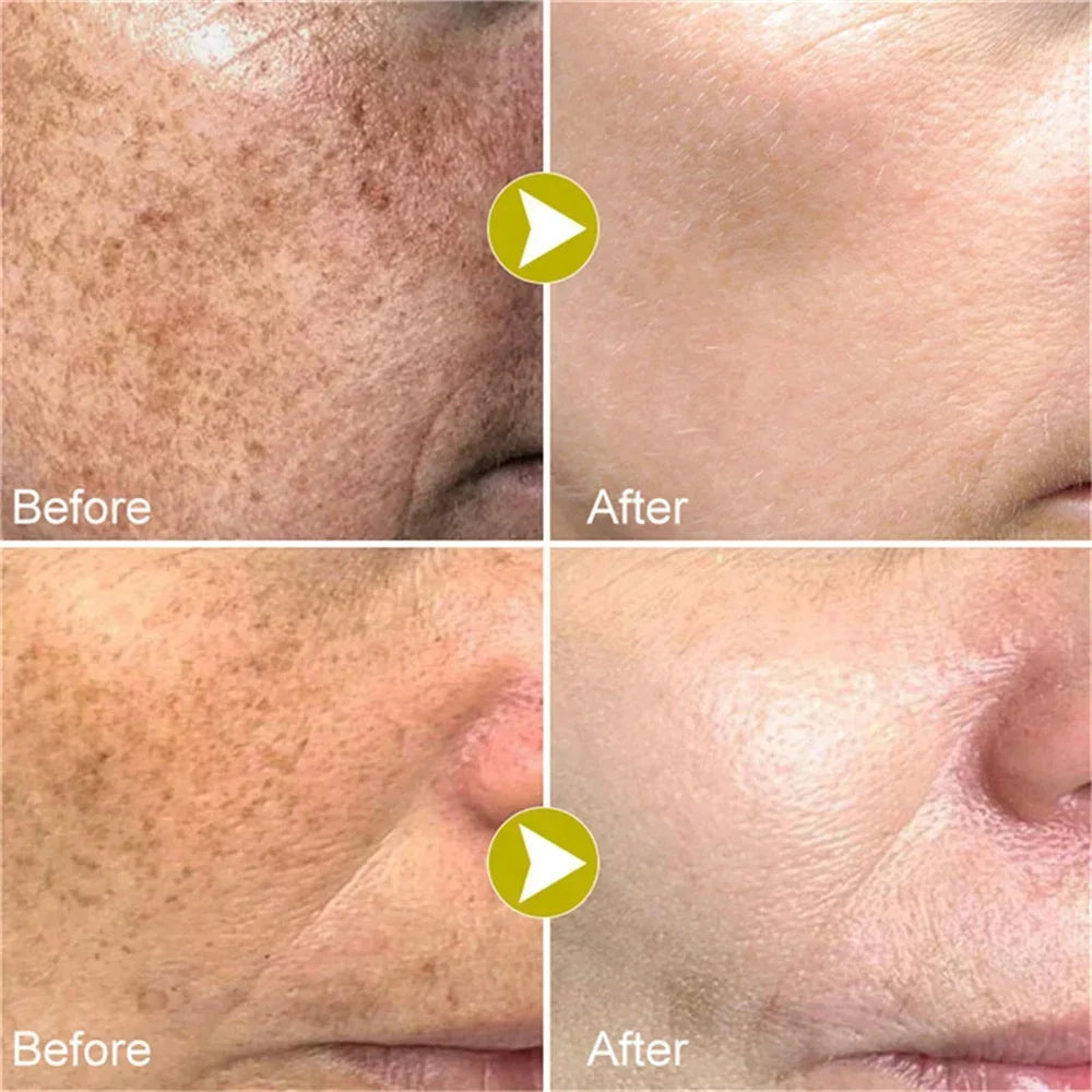 Effective Whitening Freckles Face Cream Removal Melasma Dark Spots Fade Melanin Pigmentation Corrector Brighten Repair Skin Care Peaceful Pleasures Health and Wellness