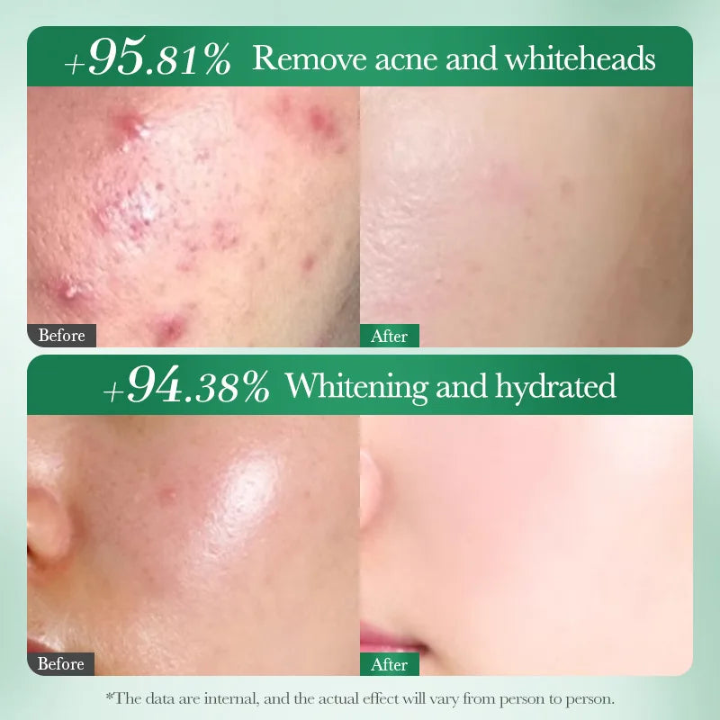 Salicylic Acid Nicotinamide Tea Tree Acne Repair Face Scar Cream Anti-Acne Deep Cleaning Pore Oil Control Moisturizing Skin Care Peaceful Pleasures Health and Wellness