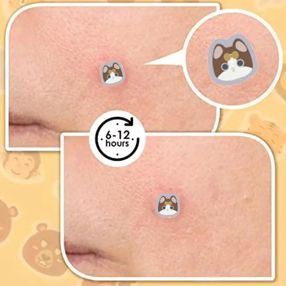 Cute Cat Cartoon Acne Patches – Hydrocolloid Blemish Dots 220pc