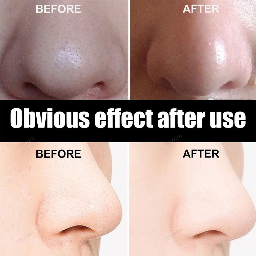10-100PC Blackhead Remover Mask Nasal Strips Black Head Nose Dot Spot Peel Off Sticker Face Acne Whitehead Pore Cleaner Nose Peaceful Pleasures Health and Wellness