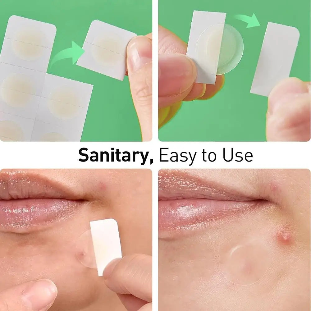 Hydrocolloid Acne Patches with Hyaluronic Acid – 12 or 48 Pack