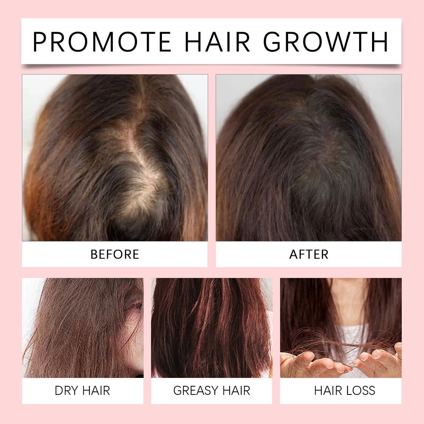 HOEGOA Biotin Ginger Hair Growth Spray – Anti Hair Loss 50ml