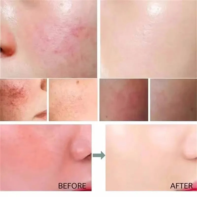 Facial Redness Repair Serum | Rosacea & Sensitive Skin Relief