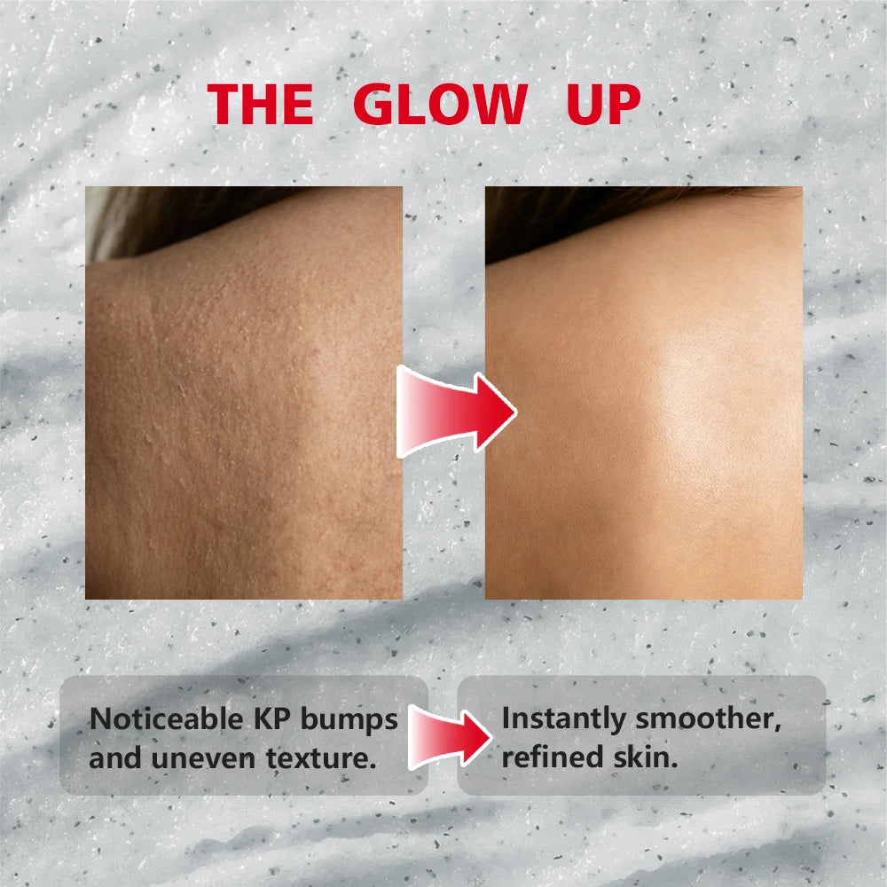 KP Bump Eraser Body Scrub Keratosis Pilaris Skin Exfoliator Helps Reduce Chicken Bumps Exfoliate to Reduce Dullness Skin Care Peaceful Pleasures Health and Wellness