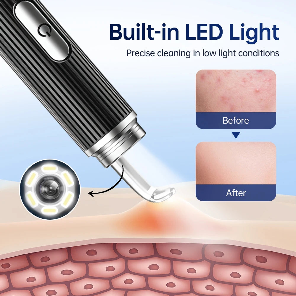 Visual Blackhead Remover with Camera Pimple Popper Extractor Tool Pore Cleaner Kit for Acne Comedone Whitehead Black Dots Remove Peaceful Pleasures Health and Wellness