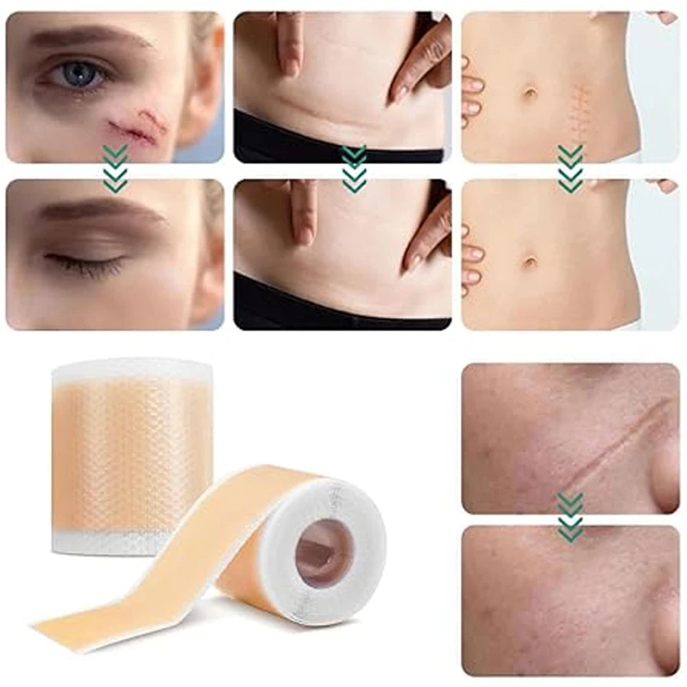 Silicone Scar Tape Roll – Keloid, Surgical & Acne Scar Sheets Silicone Scar Tape Peaceful Pleasures Health and Wellness