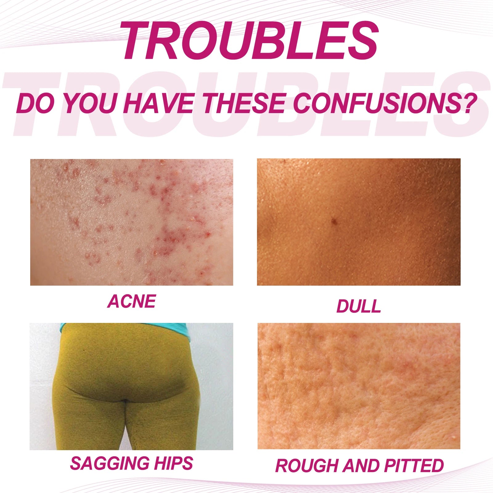 Butt Thigh Acne Cream Remove Pimples Moisturizing Clarifying Brightening Smoothing Skin Care Thigh Acne Removal Cream Peaceful Pleasures Health and Wellness