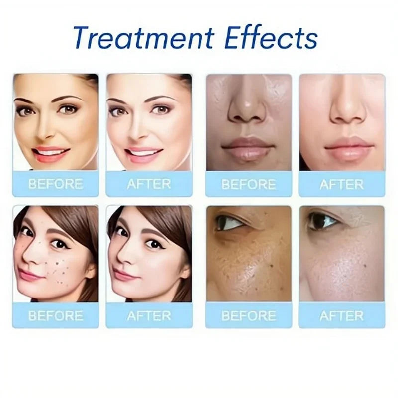 3-Piece Aqua Peel Serum Set | Hydro Dermabrasion Solution