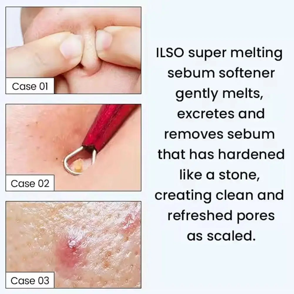 Korean Blackhead Toner 150ml – Pore Cleansing Sebum Softener