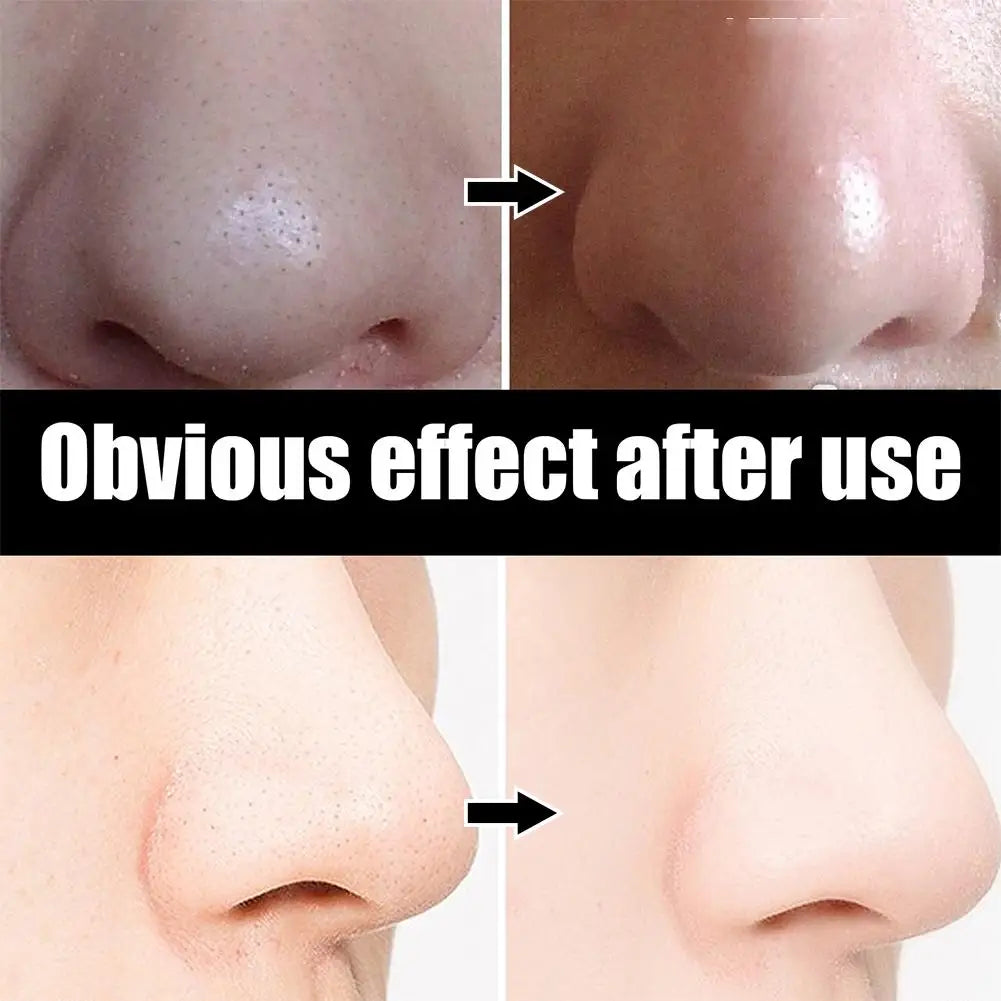 Blackhead Remover Nose Strips – Deep Pore Cleansing Nasal Patches for Blackhead & Acne Treatment 10pcs Peaceful Pleasures Health and Wellness
