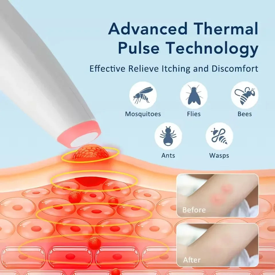 Mosquito Bite Relief Device Fast Anti-Itch Pen for Baby Kids & Adults Physical Itch Relief Rechargeable Portable Itch Eliminator Peaceful Pleasures Health and Wellness